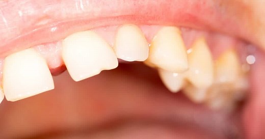 Types of Diastema and Treatment for Fixing Gaps in Teeth - Dentaly.org