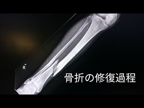 骨折の修復過程