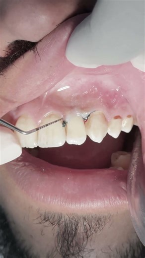 Class V composite restoration for upper lateral incisor tooth #dentist
