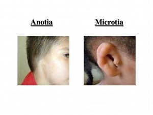 Microtia / Anotia：新生儿耳部问题 - 育儿 2026
