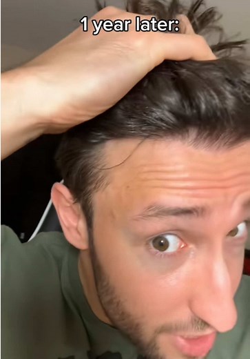 3-Year Hair Transplant Results with Now Hair Time