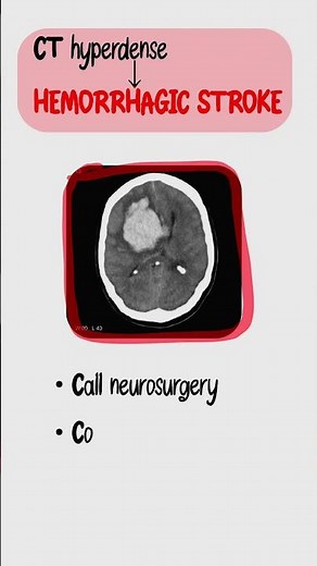 AKI in 45 Seconds: 3-Step Algorithm (USMLE Step 1/2 High-Yield)