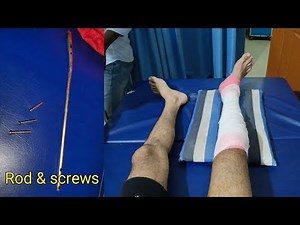 tibia fibula fracture recovery | Implants removal experience