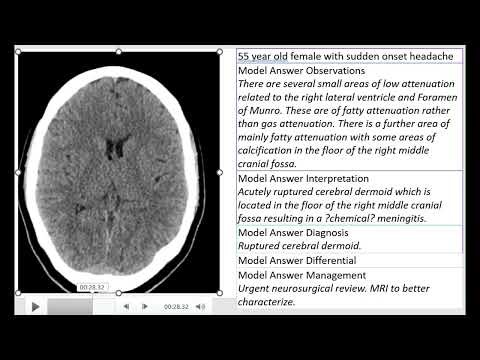 Ruptured cerebral dermoid manifested as a sudden onset headache in a female patient