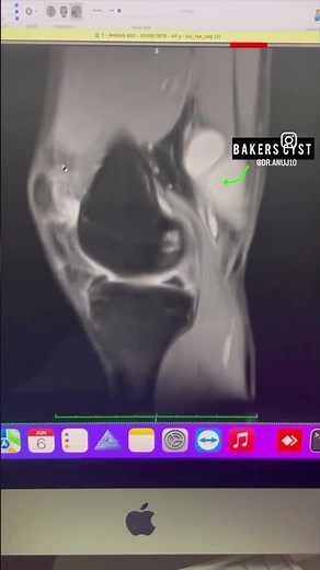Fat pad impingement in Knee MRI #msk #radiology #radiologyresident #mriscan #radioonline
