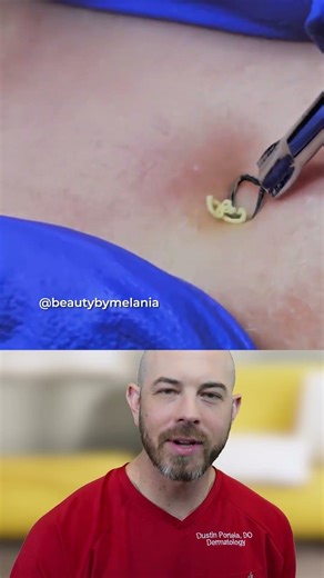 How to Safely Extract a Cyst (Tools and Method)