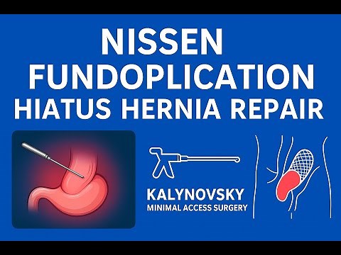 Nissen Fundoplication – Step-by-Step Surgical Procedure (Laparoscopic Approach)