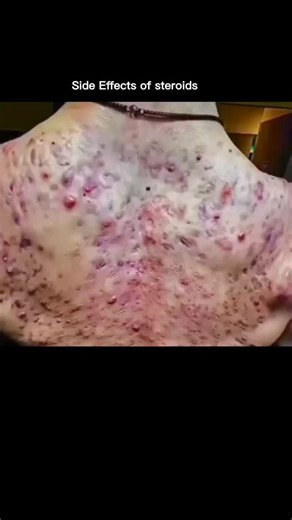 Knowledge Matrix on Instagram: "Side Effects of Steroids Steroids may look like a shortcut to quick results, but they can seriously harm your body. FORTUNE What They Can Do: Hormonal Imbalance - Can stop natural hormone production. Acne & Oily Skin - Breakouts become common. Hair Loss - Faster balding in men. Liver Damage - Can cause swelling or long-term injury. Heart Problems - Increases risk of heart attack & high BP. Mood Swings - Aggression, irritability, or depression. Infertility - Reduce