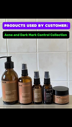 ⭐️⭐️⭐️⭐️⭐️ “I used to struggle with acne and dark marks, but this collection saved my skin!” The Acne Dark Mark Control Collection clears breakouts and fades spots — all in one routine. ✨ Fights active acne ✨ Reduces post-acne marks ✨ Reveals smoother, brighter skin 💙 Real results, real confidence. 👉 Try it today and see why everyone’s calling it a game changer! | Skin Remedy