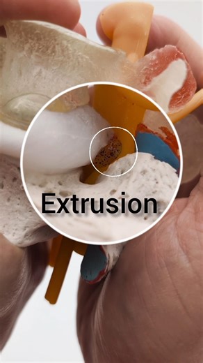 Hybrid Split Dynamic Disc Model – Lumbar Disc Herniation & Degeneration Teaching Model