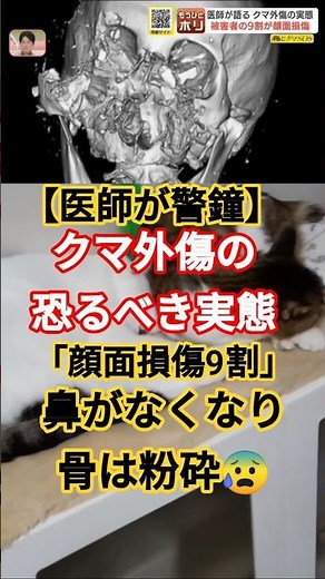 【医師が警鐘】クマ外傷の恐るべき実態「顔面損傷9割」「鼻が無くなり骨は粉砕！」FIVEニャンズ🐾 #おすすめ #shorts