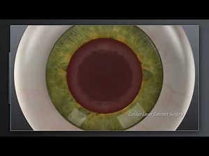 Laser Assisted Cataract Surgery With the Catalys