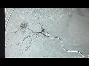 IRDOCNIGERIA Transarterial chemoembolization (TACE)