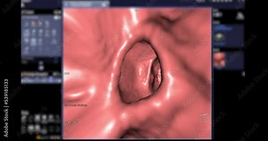 CT colonography 3D rendering footage showing intra colon for screening colorectal cancer. Check up Screening cancer of colon.