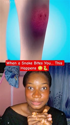 A snake bite doesn’t just hurt… it can shut your body down #disepLee Would you survive this?