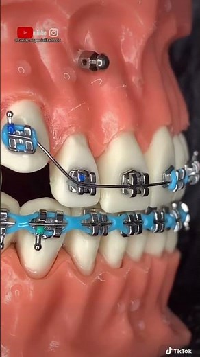 ¡Instalación de micro-implante dental en el Maxilar superior!