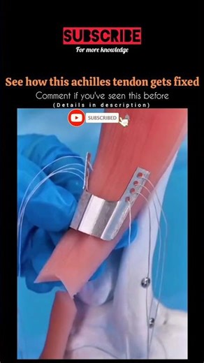 Achilles Tendon Repair Surgery। #youtubeshorts