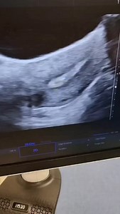 "It's the closest time me becoming a mother." Embryo trabsfer is a very emotional procedure indeed The feeling, hope, courage, and never give ups Keep showing ups If the embryo is a blastocyst- 2w5days If the embryo is a day 3 embryo - 2w3days From here- that's when we calculate the EDD (Expected Date of Delivery) Keep it up ttc 💪💪💪 | Dr Salleha Khalid
