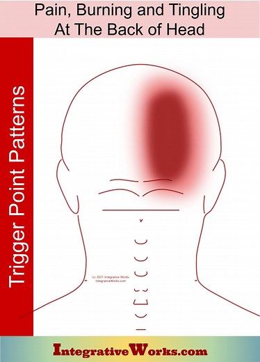 Pain, Burning & Tingling on Back of Head Cervicogenic Headache