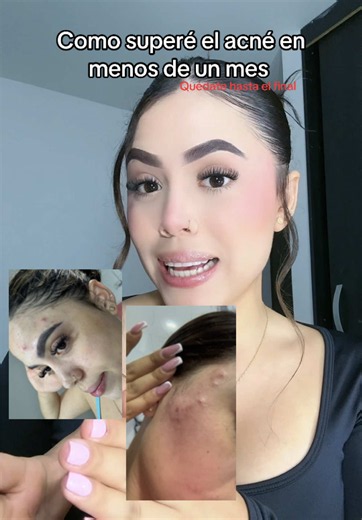 Cómo superé el acné en menos de un mes con Nia Glow