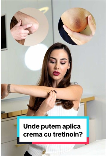 Crema cu tretinoin nu este destinată doar feței. Poate fi folosită și pe alte zone ale corpului, precum coatele, brațele cu aspect de «piele de găină», gâtul sau pieptul. Aplicată corect și sub recomandare medicală, ajută la îmbunătățirea texturii pielii și la regenerarea acesteia. ✨ Te aștept și pe tine în clinică să încerci această procedura! Lasă-mi un mesaj pentru programare. 📥 #aesthetic #bucharest #fillers #dermatology #esteticianbucuresti