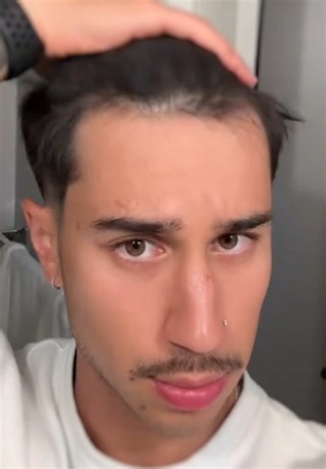 How a Derma Roller Works for Beautiful Skin