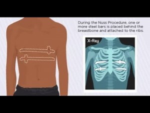 Nuss procedure minimally invasive surgical technique used to correct pectus excavatum ; Meaning