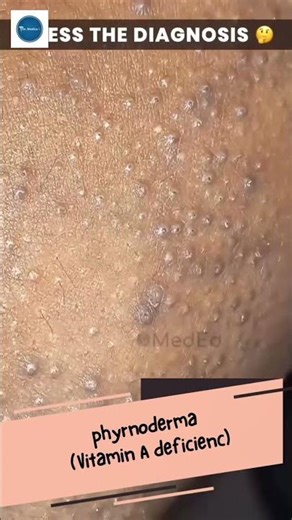 Dr Medica Clinical Cases || Pyrnoderma || Rear Medical Diseases || Clinical medicine||