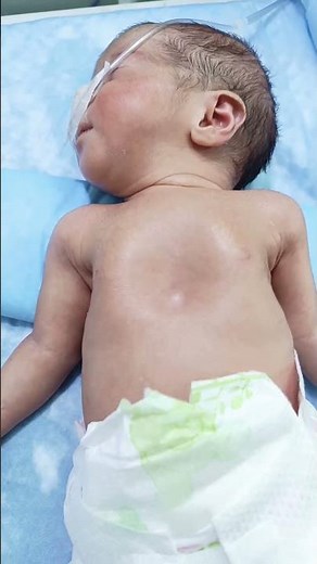NICU Newborn Baby with Respiratory Distress Syndrome (RDS) & Chest Retractions #neonatalventilation