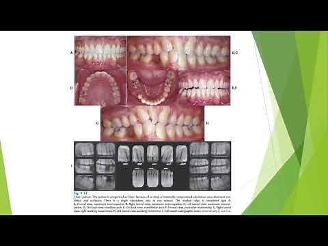 Diagnosis and treatment planning for Fixed Prosthodontics