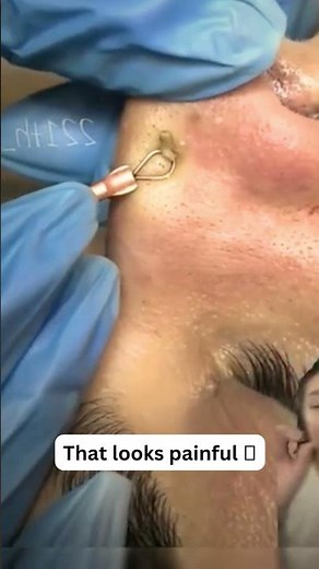 Large Blackheads Extraction Big Cystic Acne Blackheads&Whiteheads Removal Pimple Popping #1014 2026