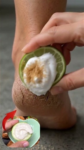 The strongest homemade recipe to deeply moisturize dry feet and heal cracked heels fast! 🦶