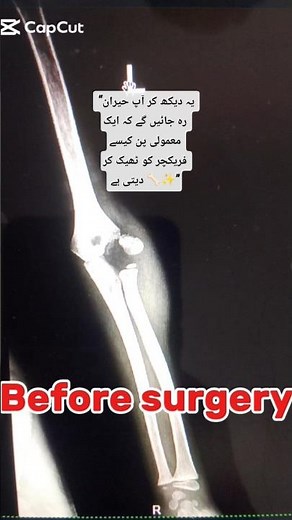 “Lateral Condyle Humerus Fracture Fixation with K-Wire | Pediatric Elbow Surgery”