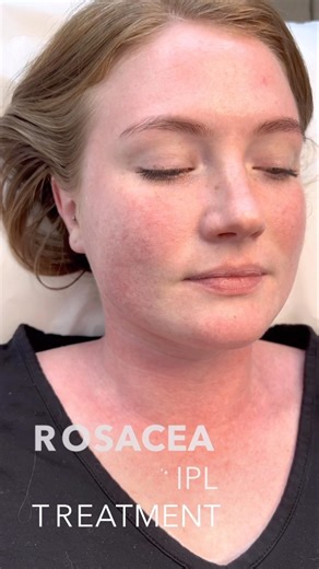Don’t let them know you’re blushing 😳 Rosacea IPL treatment aims to control the flushing symptoms and significantly reduce the diffused redness. The treatment utilizes heat from wavelengths of light to collapse the tiny red blood vessels which when dilated causes the flushing and redness. Rosacea treatment can successfully control the symptoms such as facial redness, skin sensitivity, pimples, pustules, visible blood vessels and flushing. Rosacea subtypes 1 and 2 can dramatically benefit from t