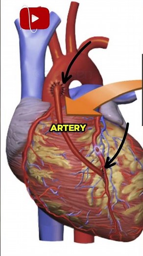 Heart Bypass Surgery Explained | A Simple Overview #hearthealth #heartdisease