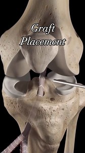 23K views · 209 reactions | ACL Reconstruction: Step-by-Step Guide to Restoring Knee Stability | Medical Talks | Facebook