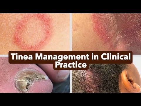 تينيا الجلد للأطباء | The Ultimate Guide to Dermatophytosis (Tinea) | Diagnosis, Treatment & Pearls