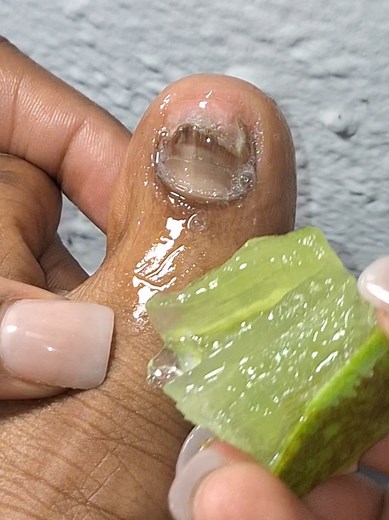 Healthy Nails: Benefits of Aloe Vera Application