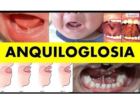 "ANQUILOGLOSIA EN BEBES"
