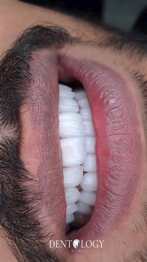 Fațete dentare Emax Premium 🫶🏼 Fațetele Emax oferă un aspect natural, translucid și elegant, transformând complet estetica dinților fără compromisuri. Rezultatul? Un zâmbet luminos, armonios și încrezător 💎