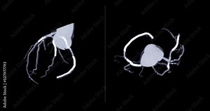 CTA Coronary artery 3D rendering image s detect coronary artery disease from CT Scanner.