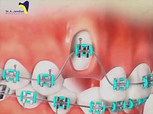 Surgical Exposure of Impacted Canine: Before & After Orthodontic Results #Canine_exposure #expose