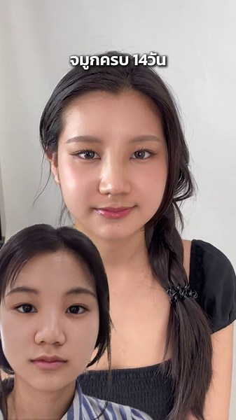 ทำก่อนสวยก่อน #หมอเกรซเลอลักษณ์ #รีวิวจมูก #genZ #พี่สาวจีน #ศัลยกรรมจมูก