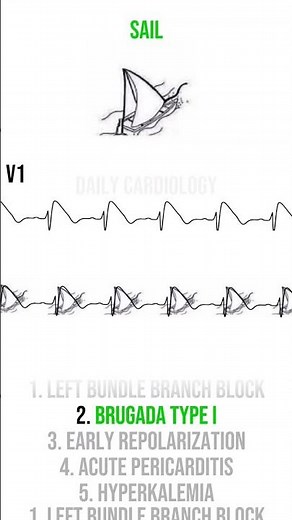 Electrocardiograma , bloqueo de rama , síndrome de brugada , infarto