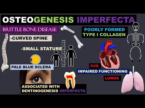 OSTEOGENESIS IMPERFECTA