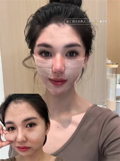 面部祛馒化打薄！ Facial dispelling and thinning!#整形 #上海 #祛馒化 #Dispel and transform