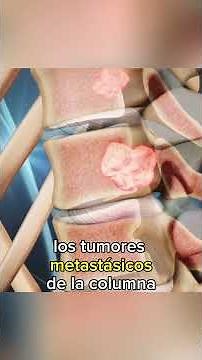 Cáncer en la columna vertebral
