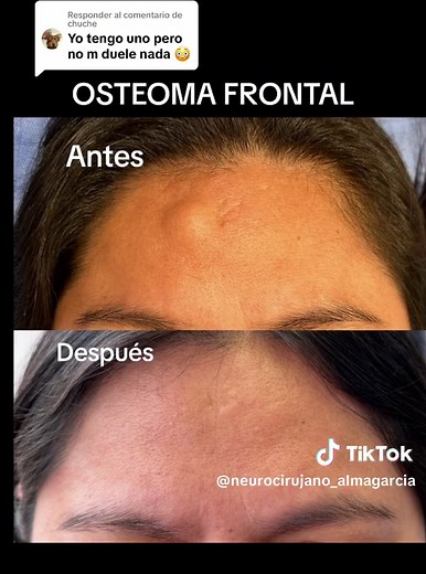 OSTEOMA: Problemas Estéticos y Tratamientos Efectivos