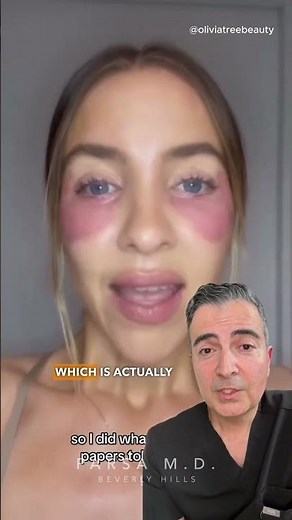 How to Treat Malar Edema Due to Tear Trough Fillers | Dr. Kami Parsa