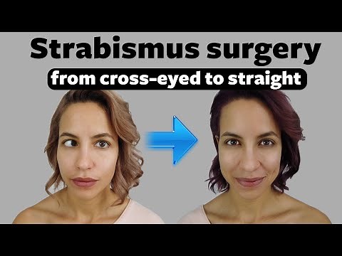 Strabismus surgery: Fixing my crossed eyes and vision